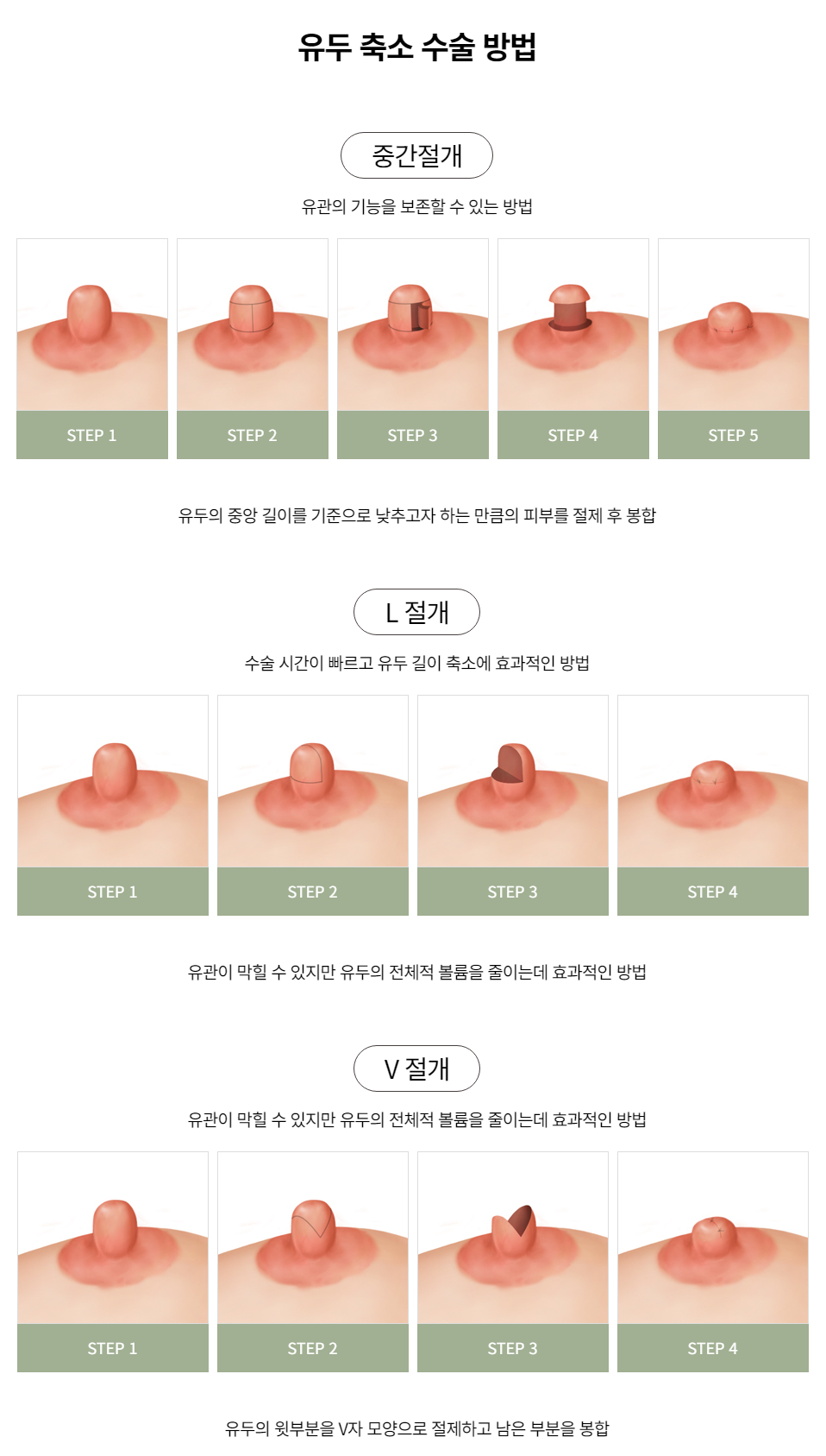 콤플렉스 개선과 기능의 회복을 동시에, 유두교정 관련 이미지 5