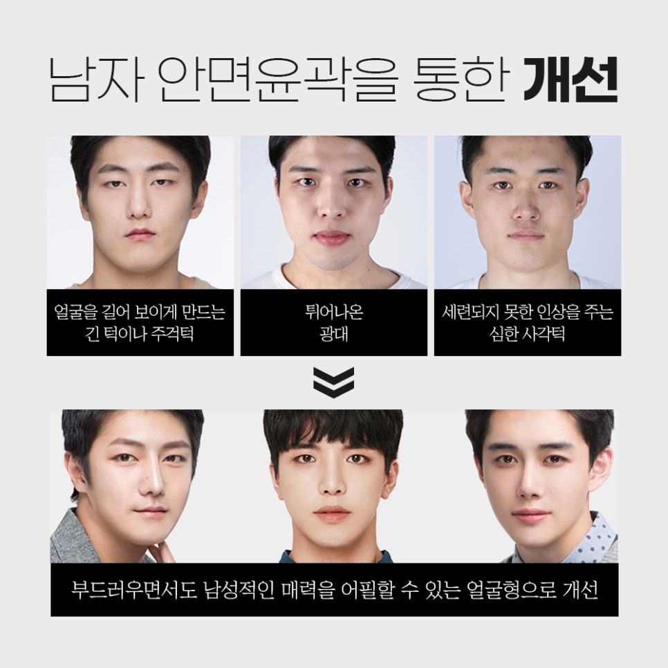 남자 안면윤곽, 남자의 포인트를 살려 정밀하게 개선해야 합니다. 관련 이미지 3