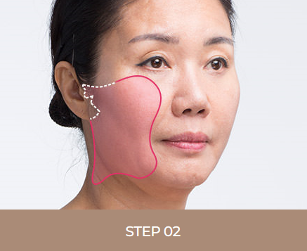 어떤 동안 성형보다 효과가 뛰어난 안면거상술 관련 이미지 4