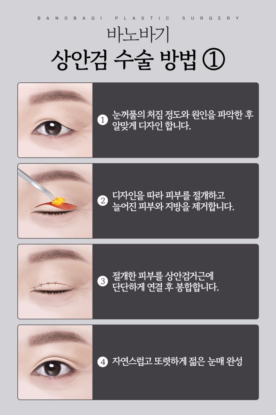 상안검, 미용적 기능적 문제 동시에 개선해 동안 눈매로 관련 이미지 3