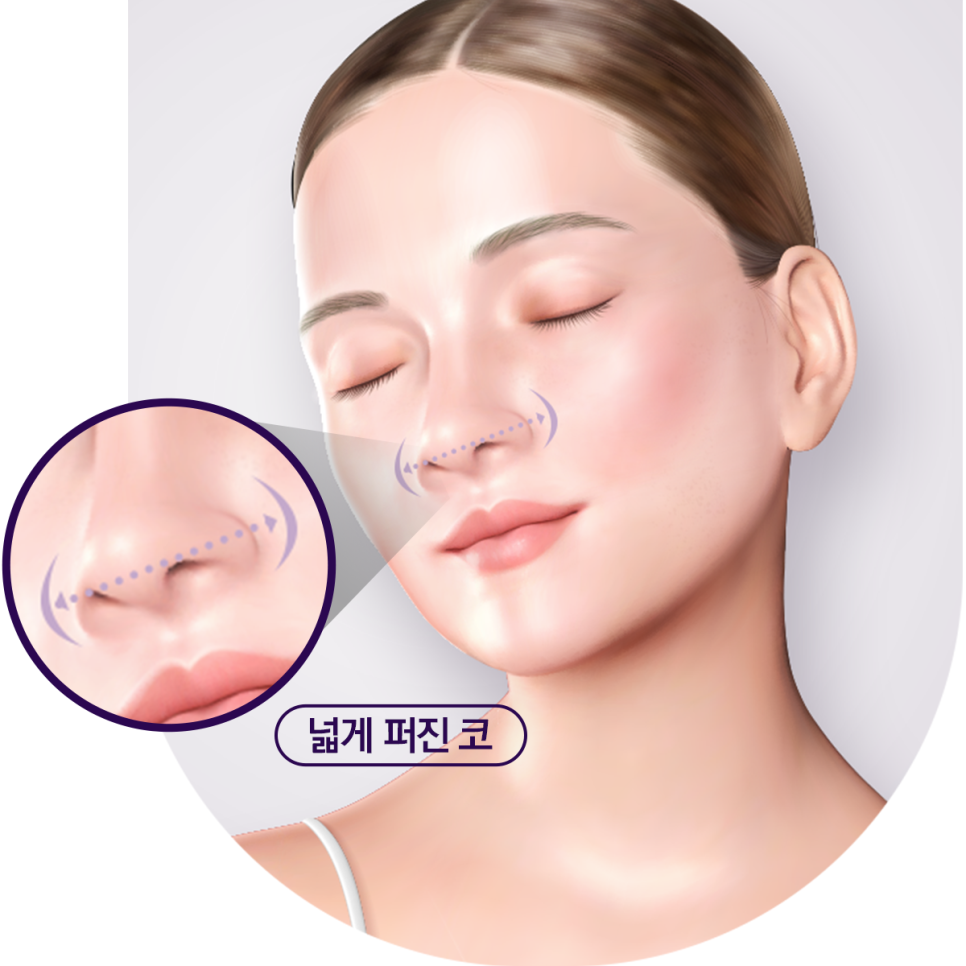 통통하고 뭉툭한 코, 슬림하고 오똑하게! 복코 성형 관련 이미지 2