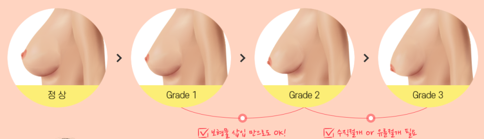 상체 지방흡입과 가슴 축소의 날씬한 조합! 듀얼슬림 관련 이미지 5