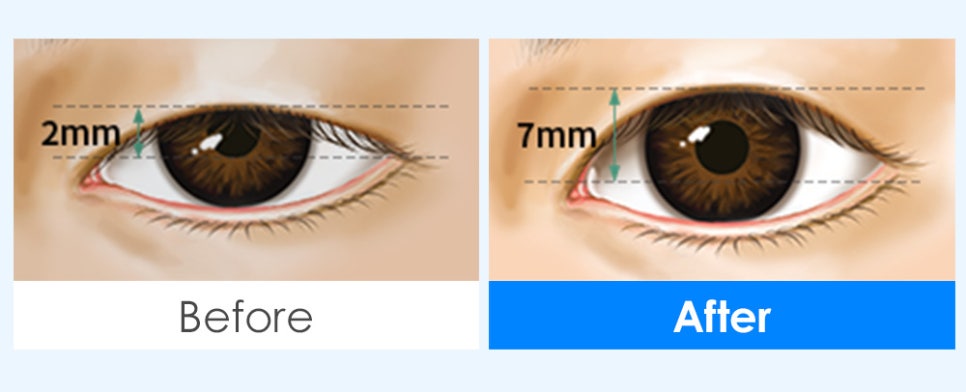 남자 눈 성형, 자연스럽고 매력적인 눈매로 개선 관련 이미지 4