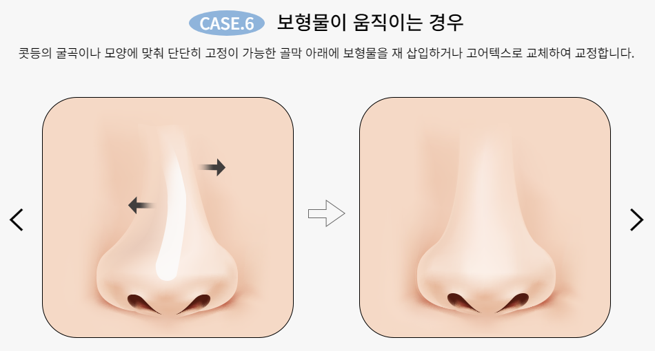 마지막 코재수술, 바노바기에서! 관련 이미지 8