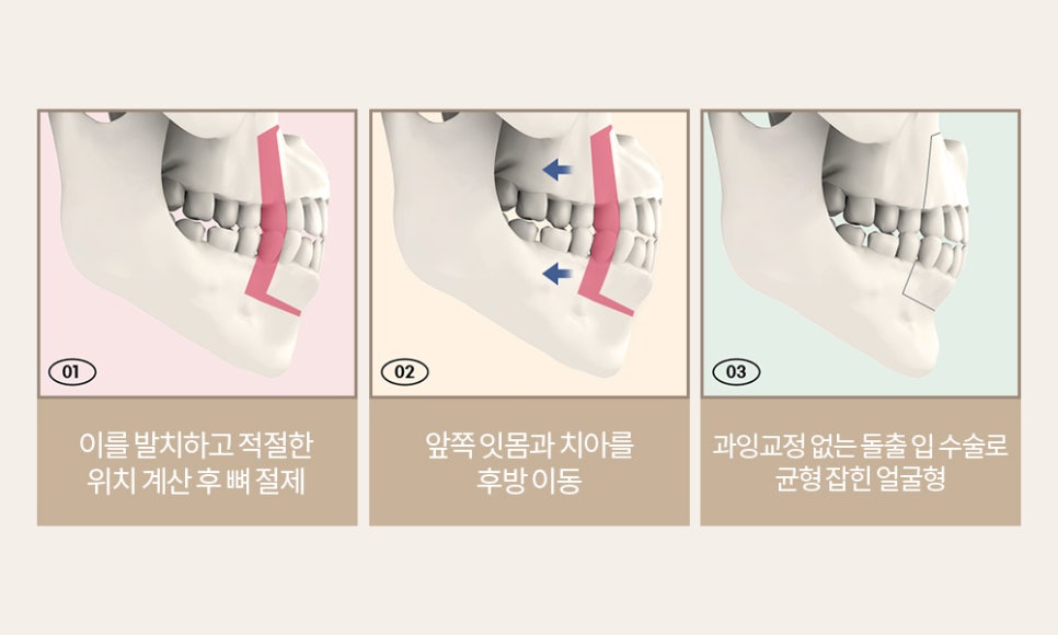 돌출입 정확한 진단으로 확실하게 개선하는 것이 중요! 관련 이미지 5