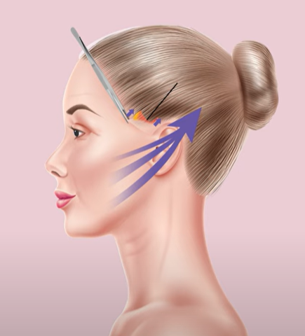 하안면부 노화는 근본적인 원인을 해결해야 한다! 관련 이미지 8