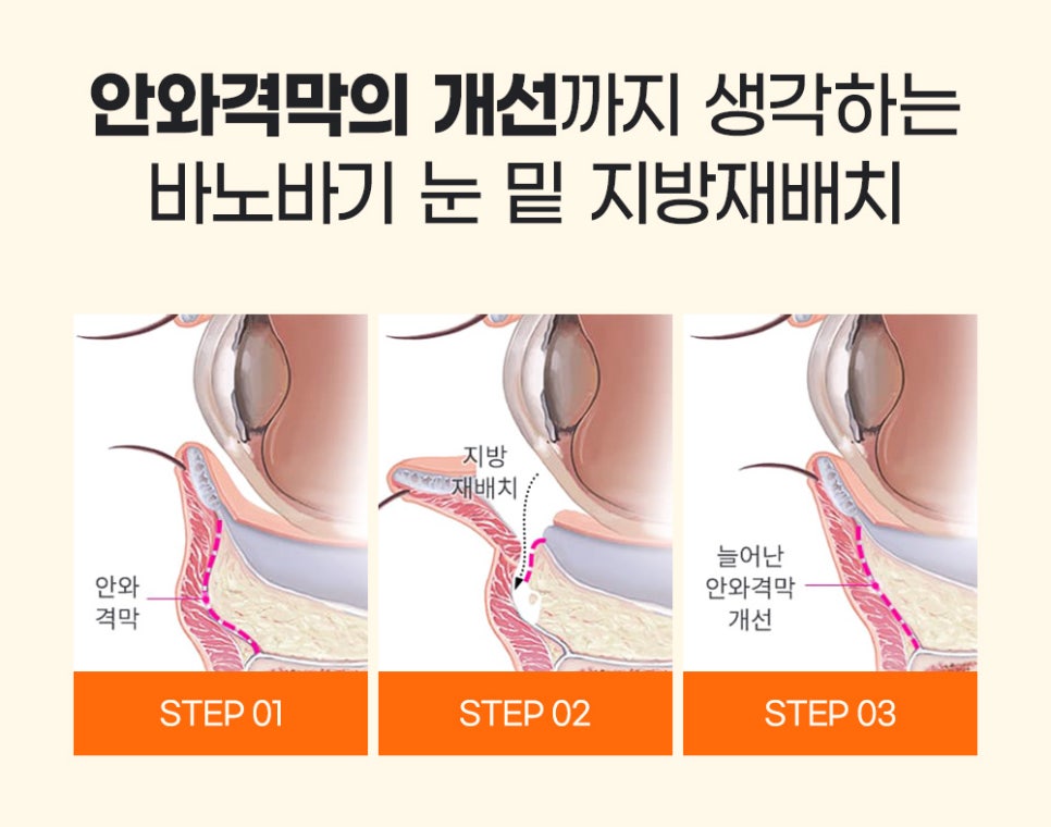 다크서클, 눈 밑 꺼짐, 눈 밑 주름 눈밑지방재배치로 한 번에 개선! 관련 이미지 5