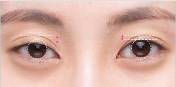 눈 재수술은 어떤 경우에 하는 걸까? 관련 이미지 5