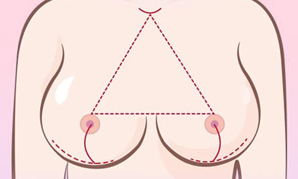 처진 가슴, 케이스에 따른 맞춤 개선으로 탄력 있고 볼륨감 있는 가슴으로! 관련 이미지 2