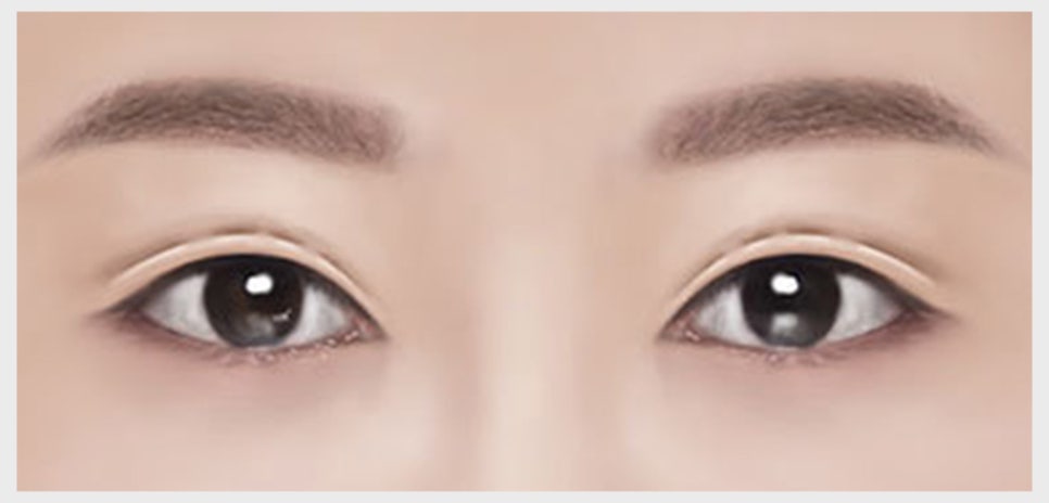 쌍꺼풀 재수술이 필요한 유형과 원인에 맞는 재수술 방법 관련 이미지 6