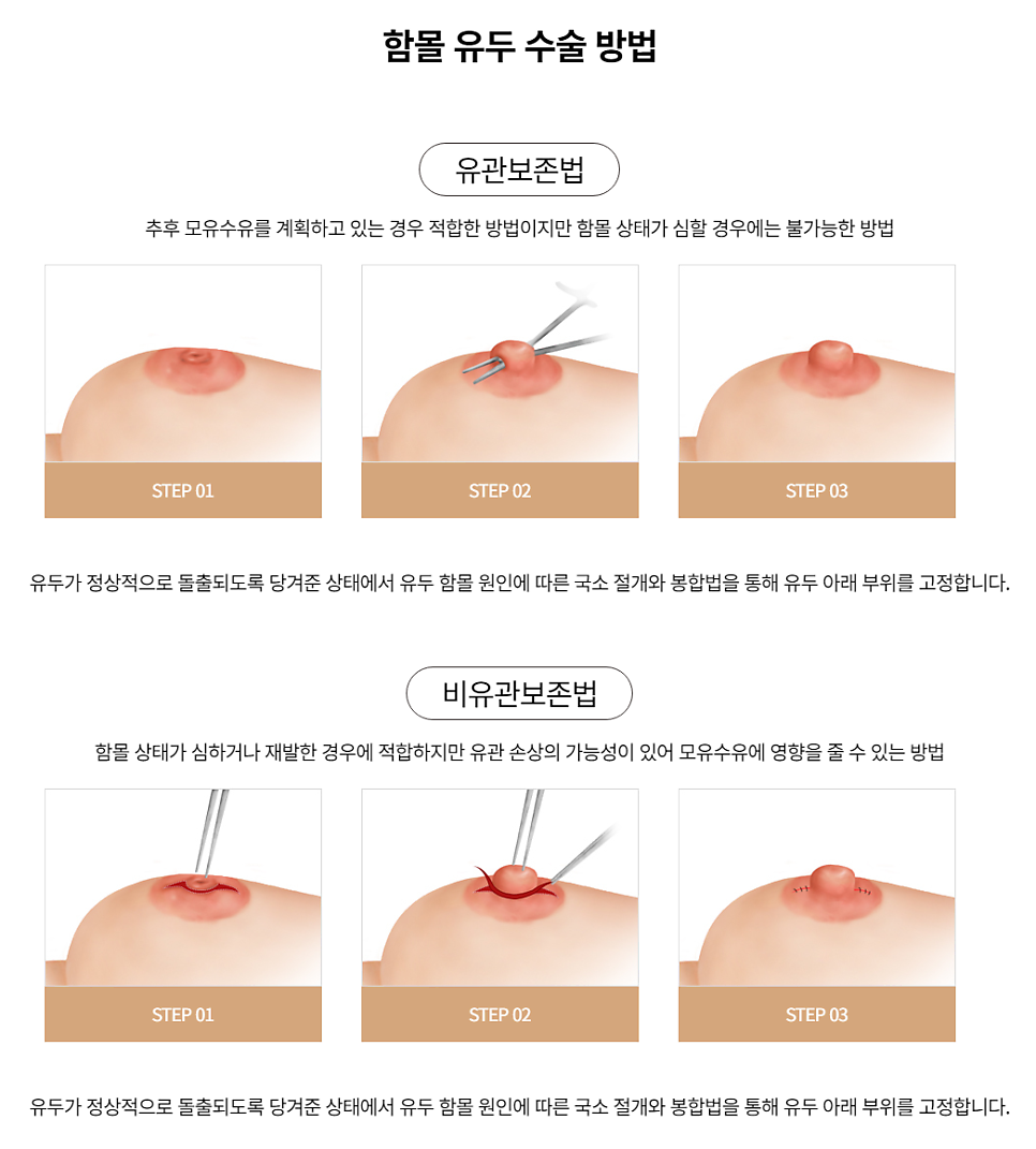 콤플렉스 개선과 기능의 회복을 동시에, 유두교정 관련 이미지 3
