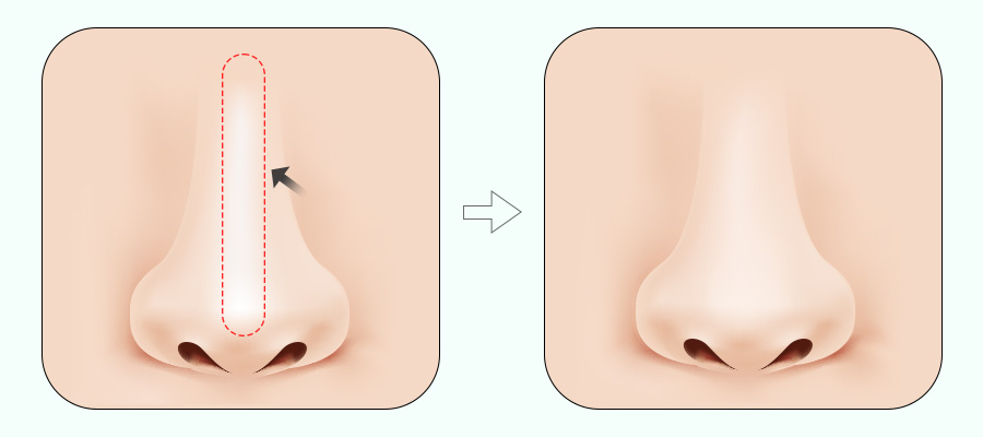 코 재수술! 원인에 따라 달라지는 수술법 관련 이미지 8