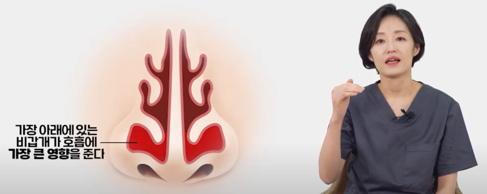 하비갑개 비후증이란?(코막힘, 콧물, 비염의 원인) 관련 이미지 2