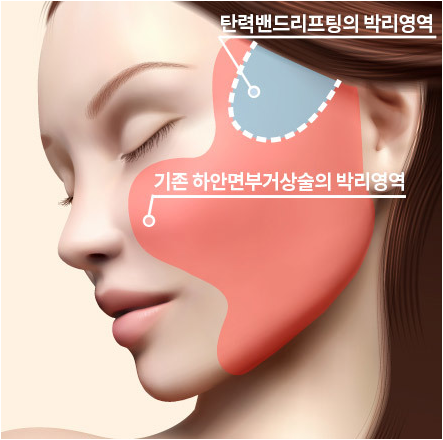 더 오래가는 자연스러움, 탄력밴드리프팅 관련 이미지 3