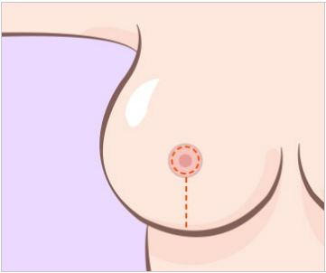 가슴축소수술, 그 이상의 의미 관련 이미지 4