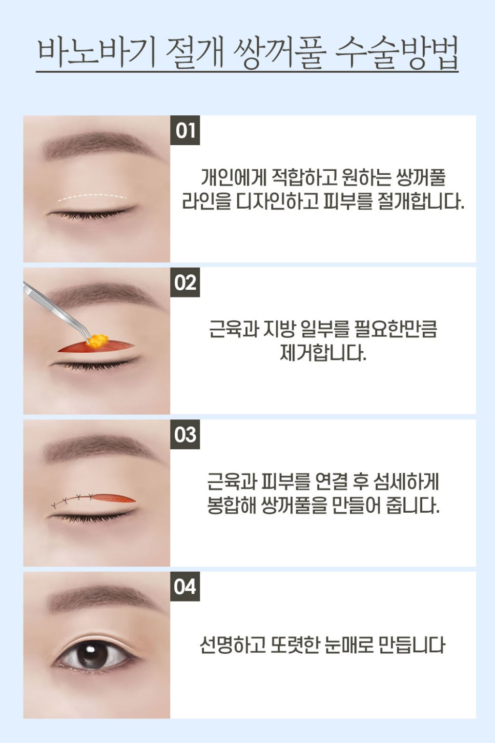절개 쌍꺼풀, 원하는 라인으로 흉터 걱정 없이 한 번에 개선 관련 이미지 3