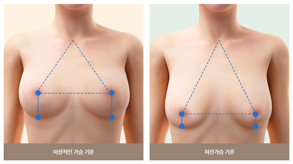 처진 가슴, 맞춤 개선으로 자신감 UP 관련 이미지 4