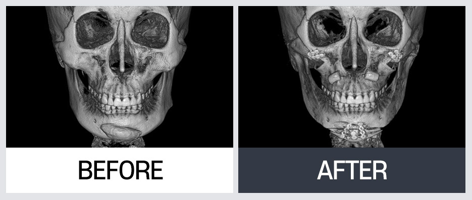 윤곽 재수술의 다양한 케이스와 수술 방법 관련 이미지 10