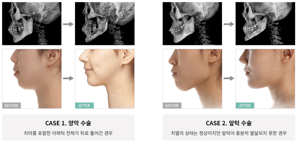 안전하고 자연스럽게, 무턱 양악수술 관련 이미지 5