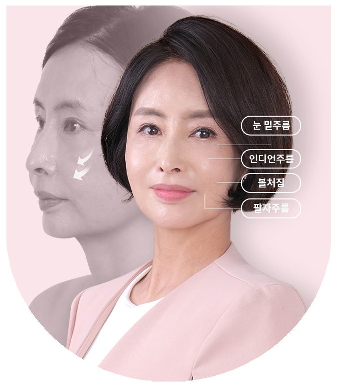 탄탄한 입체감으로 더욱 화사하게! 중안면부 리프팅 관련 이미지 2