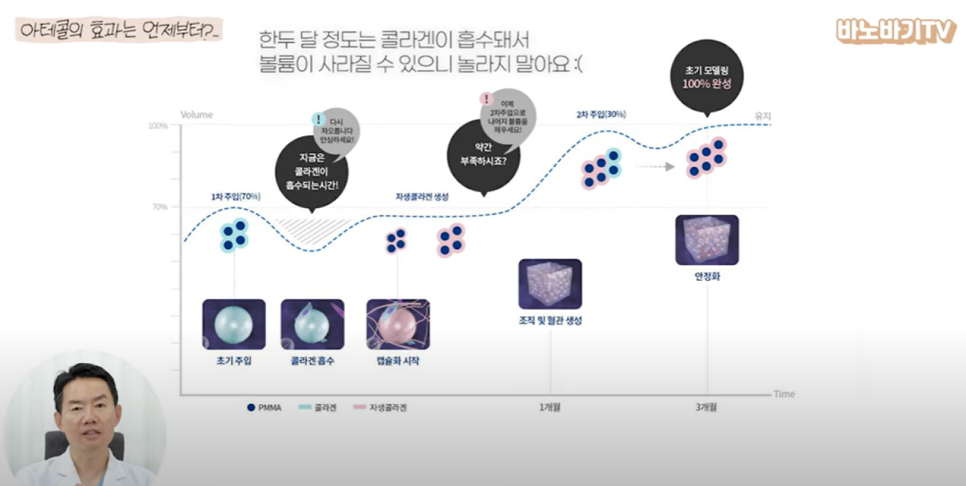 아테콜 필러의 장점과 아테콜 추천 부위는?! 관련 이미지 3