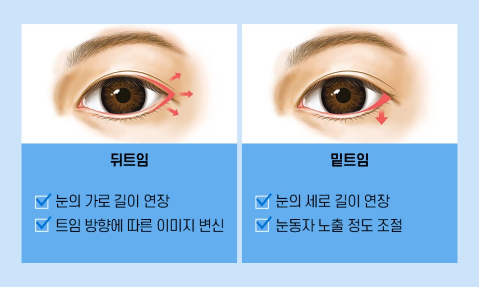 매력적인 눈매! 트임 성형만으로도 개선할 수 있습니다. 관련 이미지 4