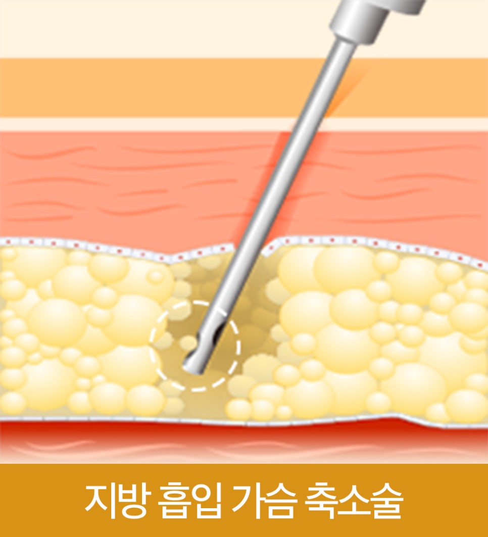 가슴 축소술, 미용적 개선과 신체 균형까지 동시에 개선 관련 이미지 6