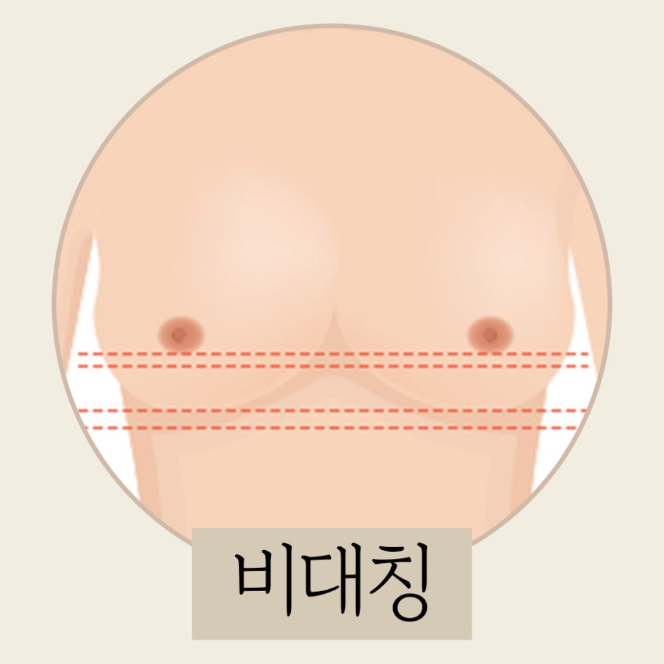 가슴 재수술의 원인과 적합한 시기 관련 이미지 5