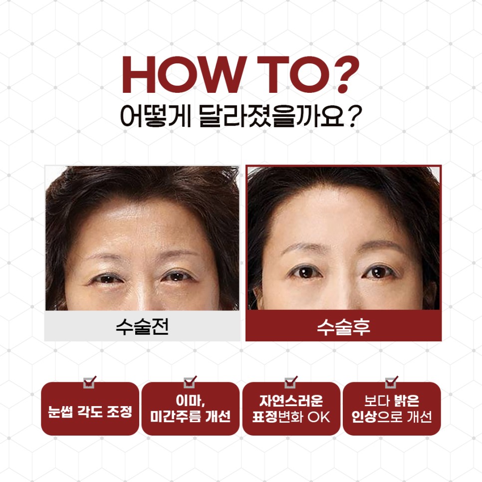 내시경 엔도타인 이마 리프팅으로 더욱 밝아지는 인상! 관련 이미지 5