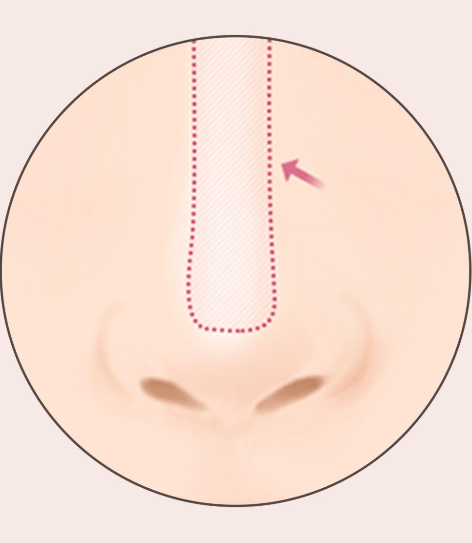 코 재수술의 다양한 원인과 개선 방법! 관련 이미지 12