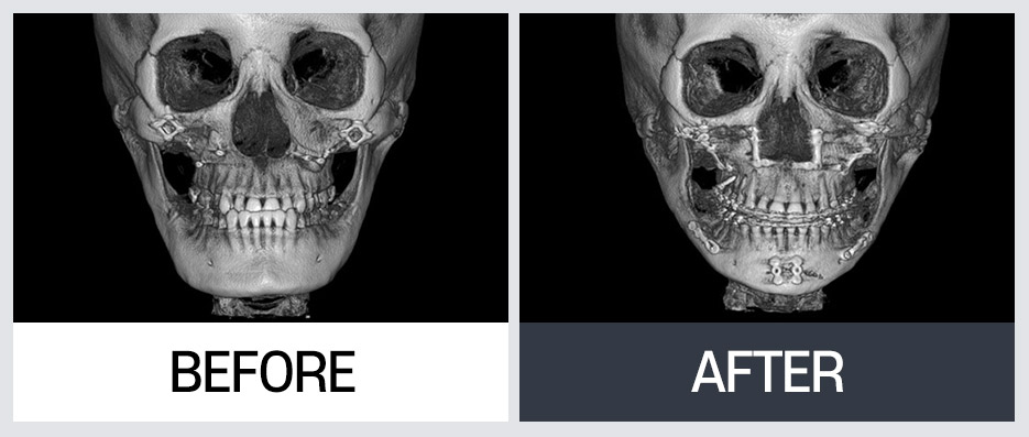 윤곽 재수술의 다양한 케이스와 수술 방법 관련 이미지 7