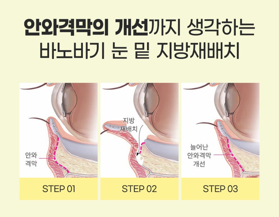 눈 밑 지방재배치로 다크서클, 눈 밑 주름 개선할 수 있습니다. 관련 이미지 5
