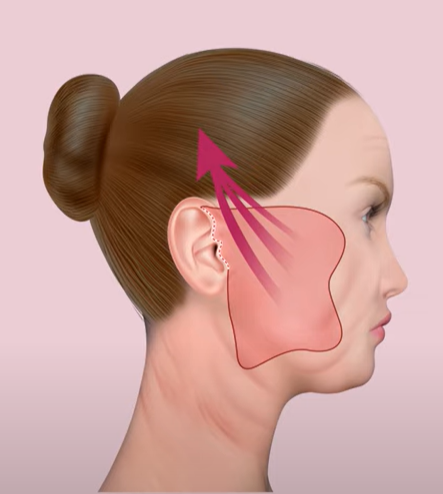 하안면부 노화는 근본적인 원인을 해결해야 한다! 관련 이미지 7