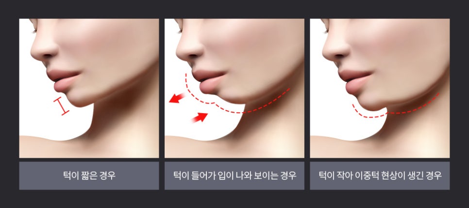 앞턱 보형물 교정이 필요한 경우와 수술 방법 관련 이미지 2