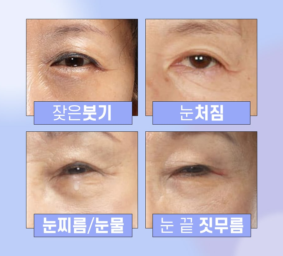 노화로 인한 눈꺼풀 처짐, 비절개 상안검으로 개선할 수 있습니다! 관련 이미지 2