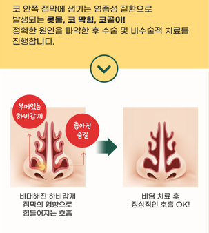 바노바기 기능코 수술 실비 적용으로 코 질환 개선과 예쁜 콧대까지! 관련 이미지 4