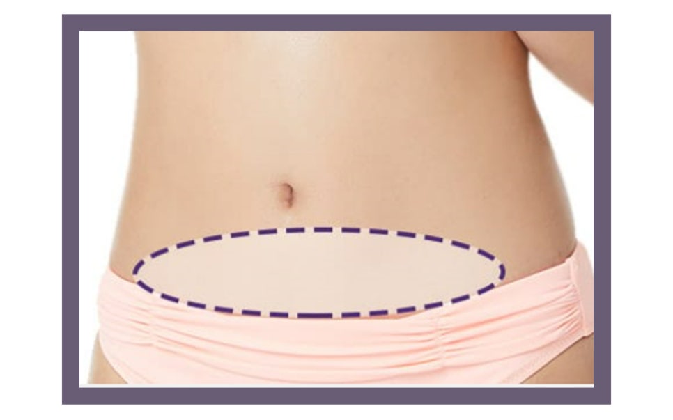 유방암 치료 후 가슴 재건 시기와 수술 방법 관련 이미지 7