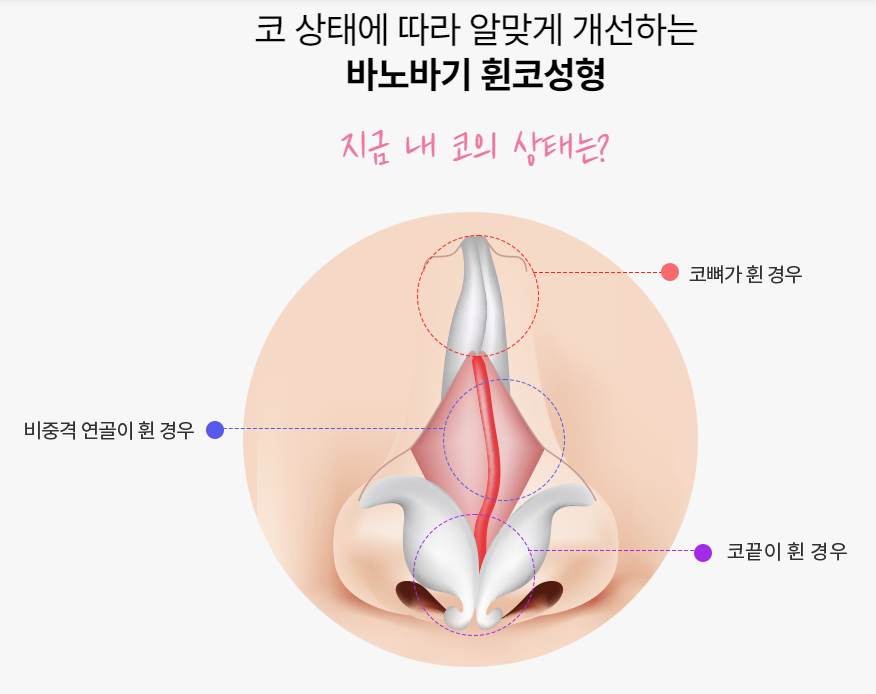 휜코, 바르고 곧은 코라인으로! 관련 이미지 3