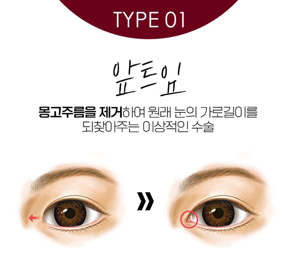 나에게 맞는 트임 성형으로 크고 또렷한 눈매로 개선 관련 이미지 2