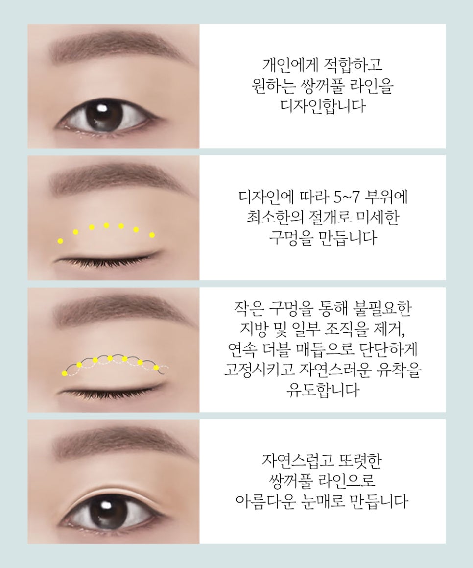 풀릴 걱정 없는 바노바기 매몰 쌍꺼풀의 수술 방법! 관련 이미지 3