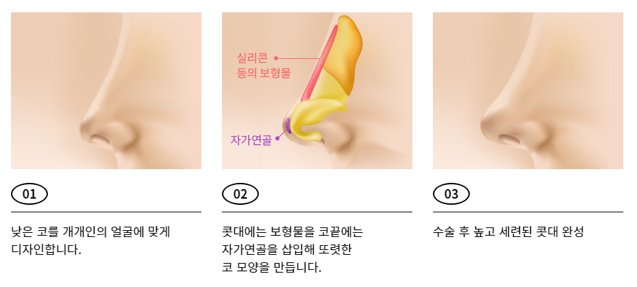 낮은 코 성형으로 입체감 있는 얼굴을! 관련 이미지 3