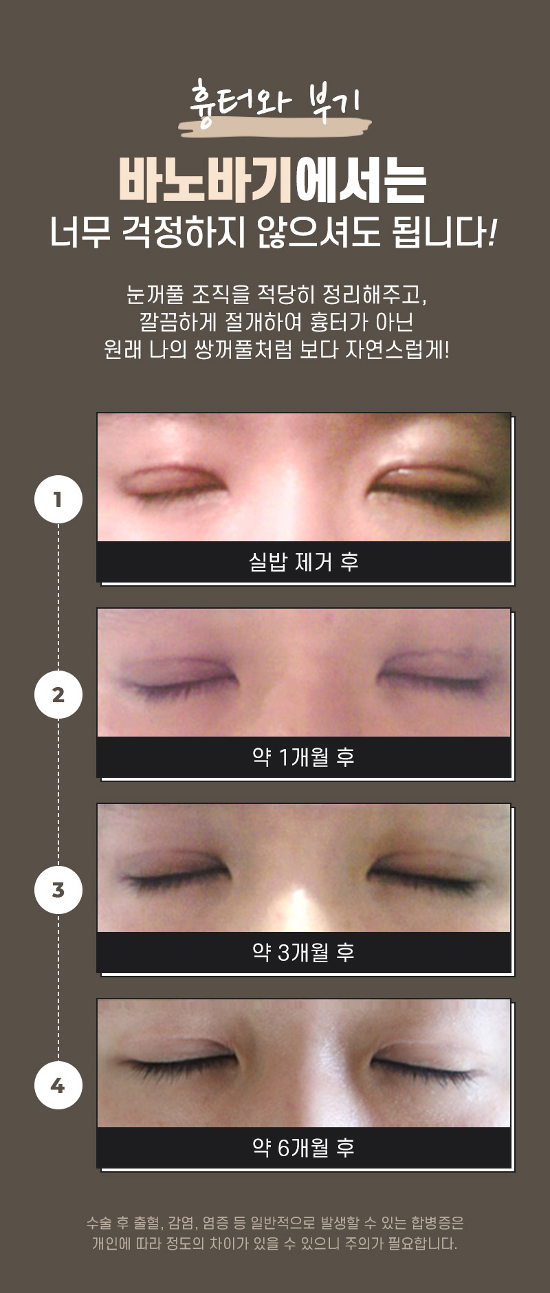 절개 쌍꺼풀의 수술법과 절개법이 필요한 경우 관련 이미지 8