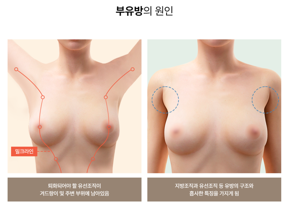 부유방 수술로 매끄러운 겨드랑이 라인을 만들자! 관련 이미지 2