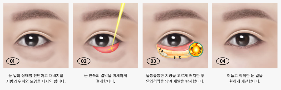 볼록하고 어두운 눈밑 정리하기! 눈밑지방재배치 관련 이미지 4