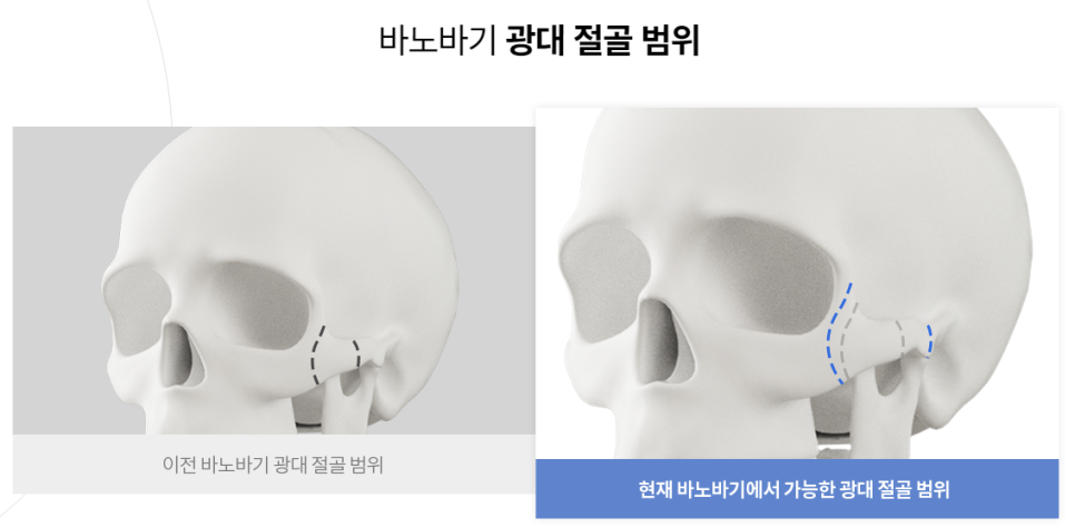 광대축소술로 작고 부드러운 얼굴형 GET! 관련 이미지 3