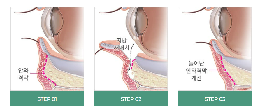 눈 밑 주름, 다크서클 눈 밑 지방재배치로 개선할 수 있습니다. 관련 이미지 8