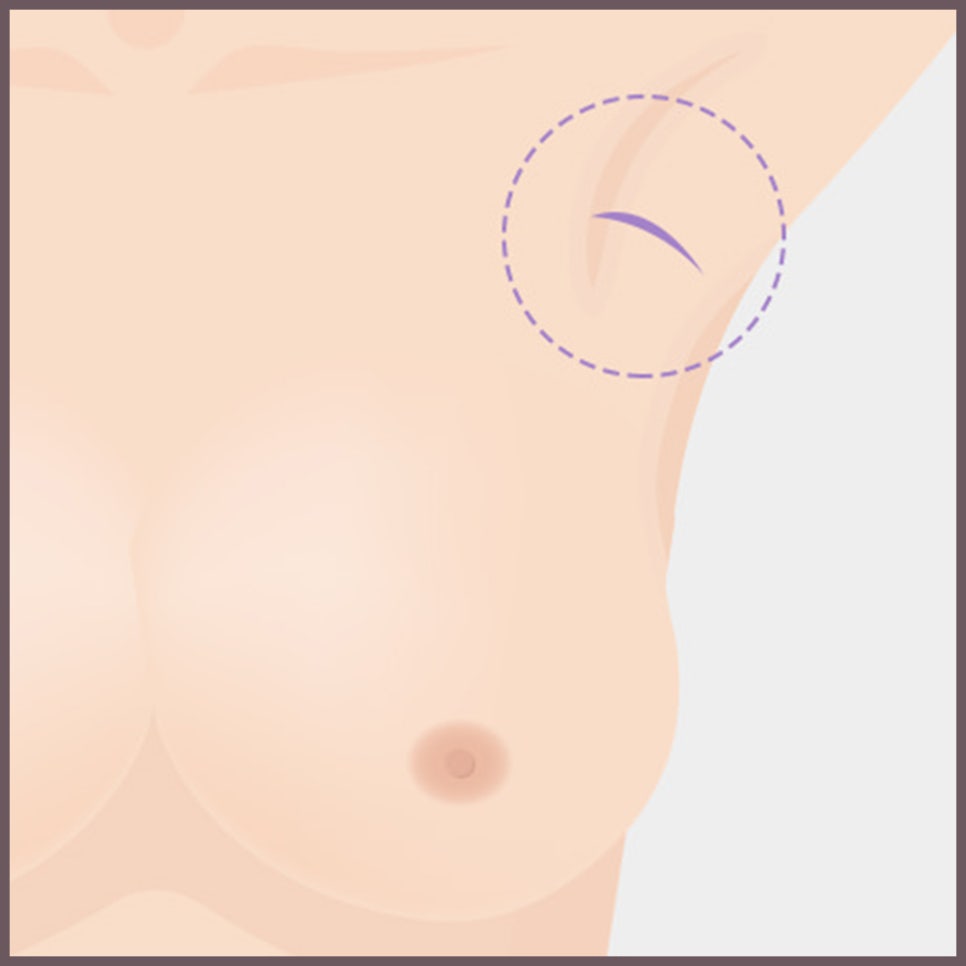 가슴 성형 수술의 핵심! 보형물의 종류와 위치, 절개법 관련 이미지 7