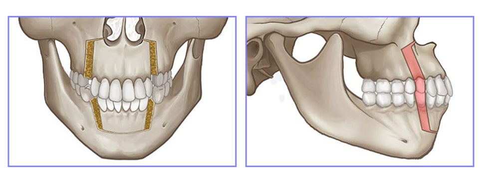 유형에 따라 달라지는 돌출입 수술 방법 관련 이미지 7