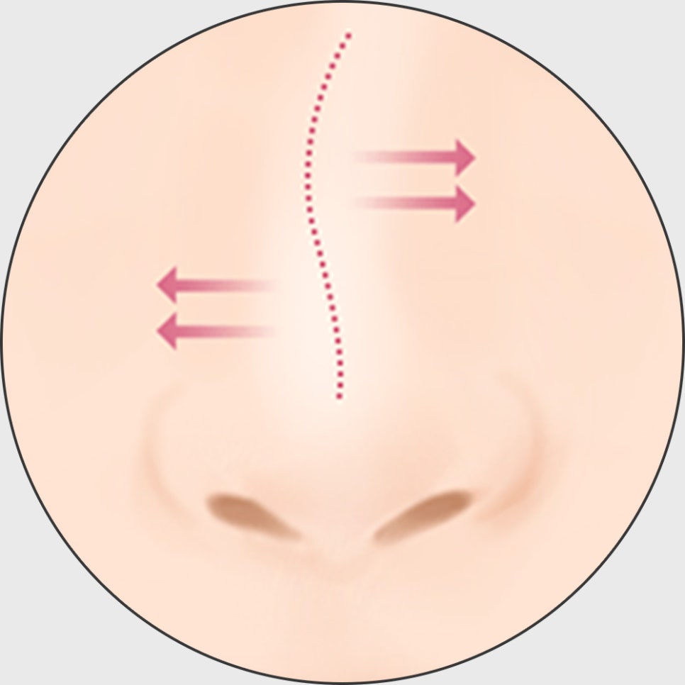 코 재수술, 적합한 시기에 원인에 따른 올바른 방법으로 개선해야 합니다! 관련 이미지 9