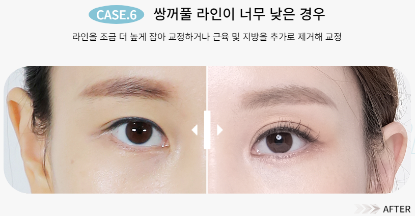 예쁜 눈매를 되찾는 방법, 눈 재수술 관련 이미지 8